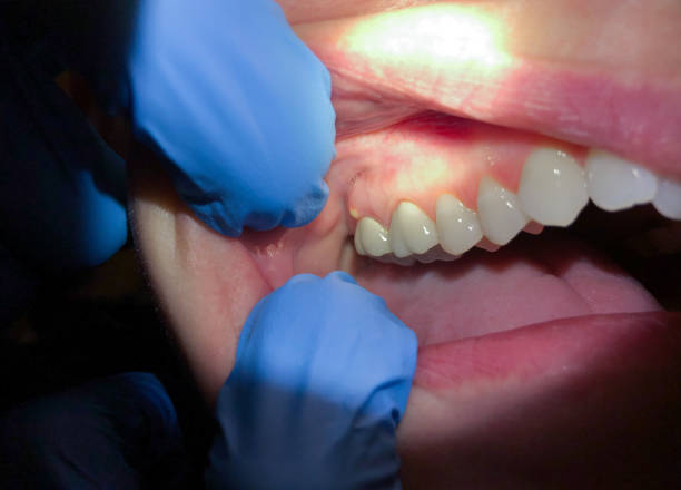 Best Emergency Dental Care for Abscessed Tooth in Indian Mountain Lake, PA