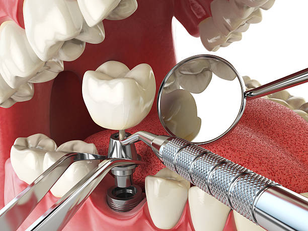 Best Emergency Dentist for Lost Fillings or Crowns in Indian Mountain Lake, PA